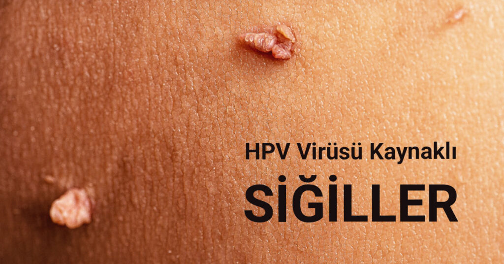 HPV Virüslerine karşı önlem alınmadığında siğillere neden olur.