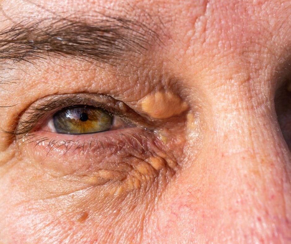 Ksantelazma ya da diğer bir tabirle göz kapağı çevresinde yağ bezesi nedenleri ve tedavisi ele alınmaktadır.