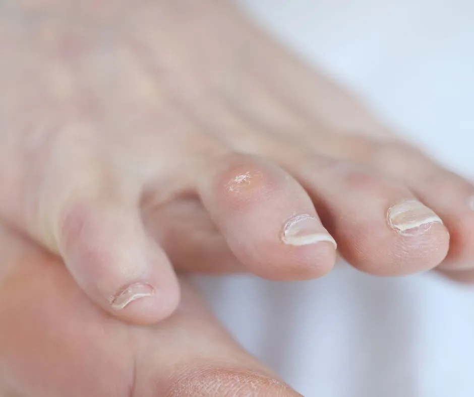 Nasır hakkında bilgiler yanı sıra nasır bandı ve ameliyatsız nasır tedavisi hakkında bilgiler yer alıyor.