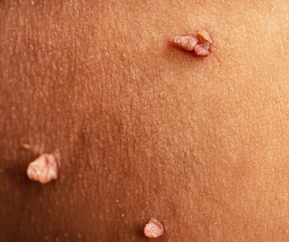 Siğil çeşitleri ve HPV hakkında bilgiler yanı sıra siğil tedavisi hakkında bilgi verilmektedir.