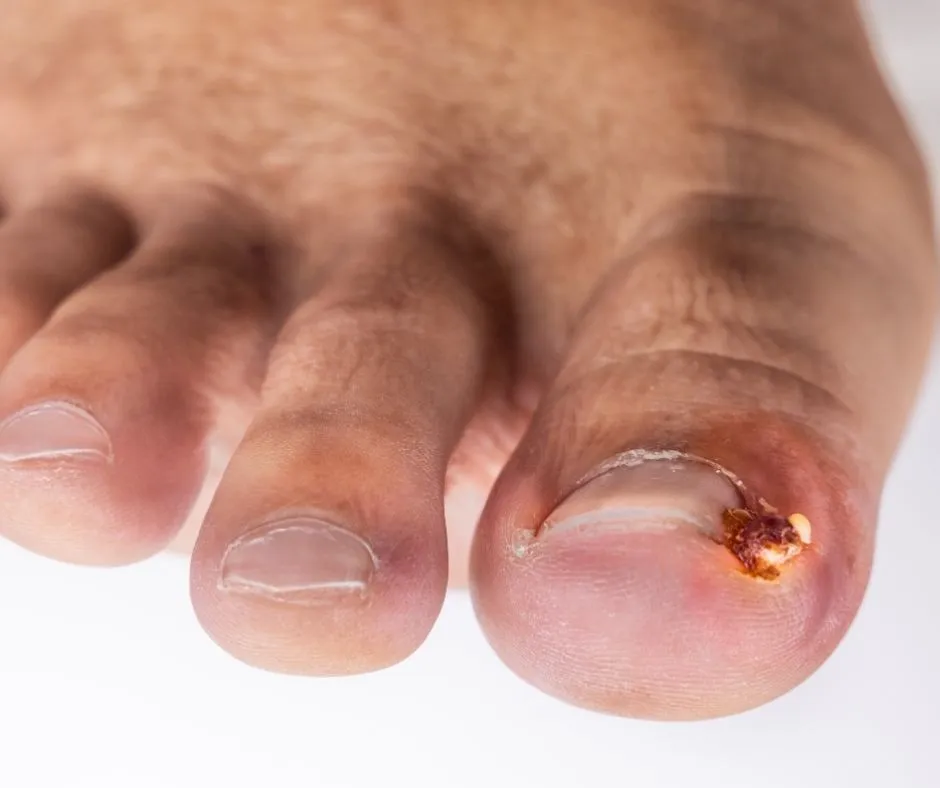 Tırnak batması nedenleri ve tedavisi hakkında bilgi verilmektedir.