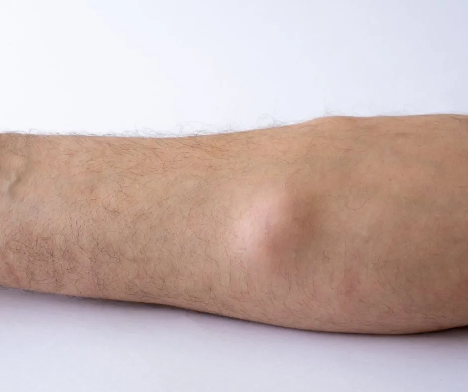 Yağ bezesi (lipom) hakkında genel bilgiler ve yağ bezesi ameliyatı hakkında bilgi verilmektedir.