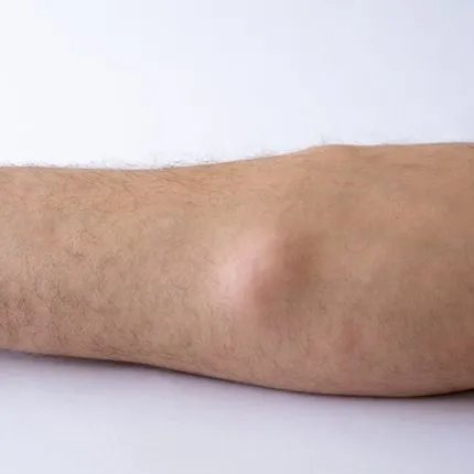 Yağ bezesi görüntüsü